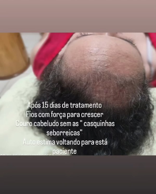 Paciente mulher após 15 dias de tratamento de reconstrução de fios